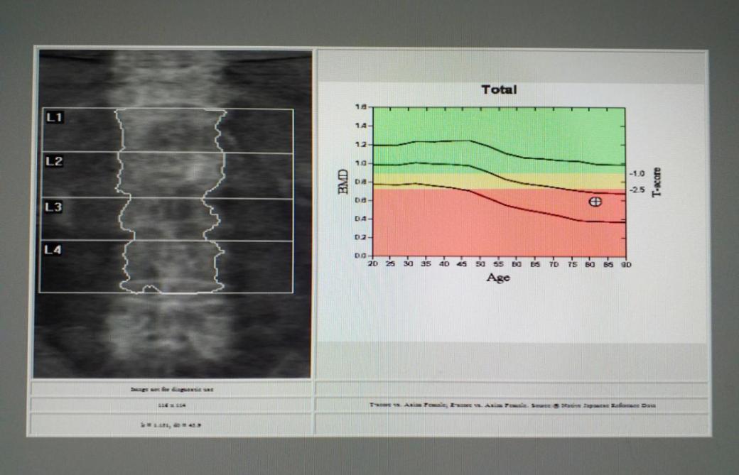 When Should I Get A Bone Density Test ColumbiaDoctors   Bone Density Scan 